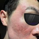 오름한의원 | [해율한의원 강남점] 패인흉터 오름테라피 1회차 &#39;듀얼 시너지 테라피&#39; 후기