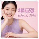 라포치과의원 | 송파구치과 교정 후기, 기간과 비용 차이가 나는 이유는?