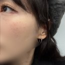 브이의원 | 다이아의원 | 피코슈어 토닝 엑셀브이 레이저 후기