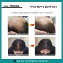 지성 | 운정탈모관리 추천 닥터모다르 파주점 지성두피 케어 후기 파주두피 관리 경험