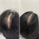 역삼-1683 | 김포탈모커버 잘하는곳/두피커버 숱채움 잘하는곳 필릭스 스칼프라면 만족도 최상!