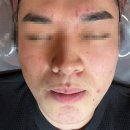 세븐일레븐청라린점 | 청라 피부관리 디또뷰티 염증성 여드름과 홍조 탈출기 슈퍼젝션 디바이스 케어