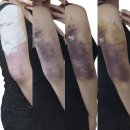 멍머리 | [팔뚝 무한람스 12일차 상세후기] 멍,붓기,통증, 후관리