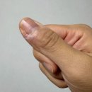 손톱 거스러미 뜯다 생긴 염증 [생손앓이/조갑주위염] 셀프 치료하다 병원 간 후기