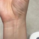 손목쪽힘줄 palmaris longus맞나요.. 이미지