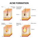 명현 | 약사가 말하는 여드름 경구약 "이소티논" (실 복용후기와 부작용, 명현 현상)