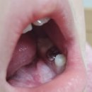 리앤치과의원 | 안산키즈치과 {리앤키즈치과} 충치 신경치료