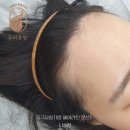 브라운도트 수원정자점 | [분당헤어라인문신] 가격/유지기간/부작용, 전문가가 밝히는 2026년 최신 가이드 (30대 안개기법 후기)