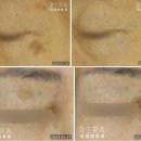 리라피부과의원 | 압구정 흑자 제거, 레이저 치료 1회로 없애는 법(리팟레이저 대신 )