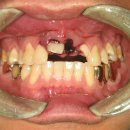 외상으로 인한 치아 함임, 파절 이미지