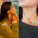 목주름필러 선릉역피부과 내돈내산 후기(+전후비교,멍,통증)