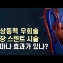 관상동맥 우회술 심장 스텐트 시술 이미지