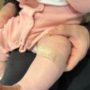 지니성형외과의원 | #5.대구 닥터지니성형외과 선천성멜라닌세포모반 제거 수술 후기｜실밥 제거 1개월 후 흉터 레이저 치료