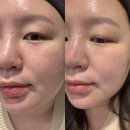 30대피부관리, 선릉역피부과에서 미라젯쥬베룩 1차 후기(내돈내산/피부통증/효과)