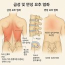 허리를 삐끗했나요? 급성 요추 염좌부터 만성 요통까지, 제대로 알고 대처하세요! 이미지