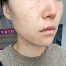 경산바른약국 | 경산 효성의원 대구경산 편평사마귀쥐젖기미점 빼기