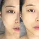 지에스25동구동촌로점 | 대구 동구 피부과 추천 / 대구 에스테틱 맛집 / 기미관리 + 프락셀 받은 솔직후기 [홍화뷰티]