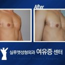 여유증 수술 제일 잘하는 곳은 실루엣 이미지