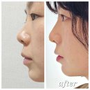 강남 코필러가격 2cc 내돈내산 콧대필러 후기 가격, 통증,붓기 정보