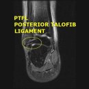 발과 발목 MRI (Foot and Ankle MRI) 영상진단 이미지