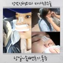 복코찜이 | 강남 성형외과 코수술 내돈내산 후기 1탄 자가늑 통증부터 솜 빼기 전후 변화까지 찐기록