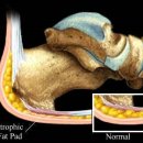 족저근막염 이미지