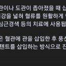 ■ 협심증, 급성심근경색 수술에 사용되는 기술력 이미지