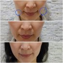 엘라비 | 부산 리투오 스킨부스터 후기 주의사항｜40대 후반 피부 변화, 직접 받아본 리얼 경험