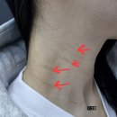 [합정 편평사마귀 성지 연세보드미의원] 2탄 - 어븀야그 레이저 4개월 후 그리고 듀오덤 흉터