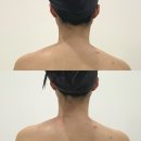 수원-1520 | 웨딩관리 | ‘에스테틱다리아 수원본점’ 승모근, 비대칭 잡아주는 ‘등신경테라피’ 관리후기