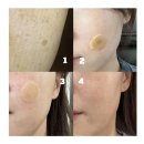 바로그의원 | 구미 바로그 의원 - 색소 침착, 흑자 제거, 리팟레이저 후기