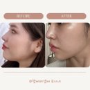 경복에너지 | 역피부과 &amp; 얼굴소멸패키지 V라인 패키지 통증없이 울쎄라300샷 받은후기+무중력주사+v라인주사 만족후기