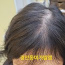 경기 광주(경안동미가발)여자정수리가발로 변신하신 고객님 리얼후기~
