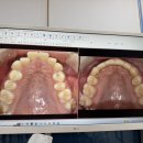 더원치과의원 | 구리 더원교정치과 교정 후기 (+교정 전후 사진 有)