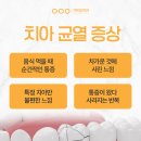 56 | 선암동치과 치아 균열, 그냥 두시면 안 됩니다