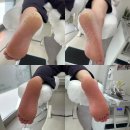 MS마트(후평점) | 춘천 발 뒤꿈치 갈라짐, 레푸스 후평점에서 해결한 찐 후기 (여름 준비 끝)