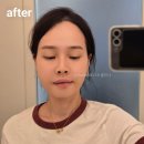 바늘향기 | 압구정피부과 꺼진 얼굴 필러대신 올리디아 볼륨 후기 내돈내산!