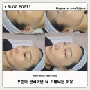 홈플러스 춘천점 | 춘천기미 고민된다면? 영앤브라이트에서 받은 피부관리 후기