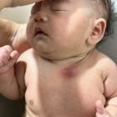 김현영 | 서울대어린이병원 50일 2개월 아기 새열낭종 김현영 교수님 외래 진료