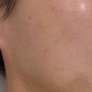 브이메디 | 압출 안아픈 부평 피부관리 브이메디스파 | 여드름 홍조 수분관리 후기