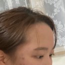 자라나라 모발모발 ~헤어라인 문신에서 모발이식까지의 일대기~ (전/ 후 사진O)