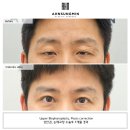 민성형외과의원 | 40대 남성 눈매교정 수술, 안검하수 개선과 자연스러운 회복 과정