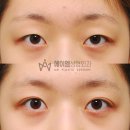 눈재수술 167. [비절개눈매교정회복, 일주일, 안검하수 교정, 쌍수한달후기, 쌍꺼풀 수술 시간]