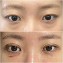 대전댁 | [2주차 후기] 30대 초 상안검·하안검(+지방재배치)