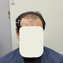 진짜 고객님 손님의 후기가 있는 헤어증모술은 증모여왕햇살의 코르셋 증모술입니다.