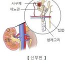 항이뇨호르몬 부적절분비(분비이상)증후군 (SIADH) -저나트륨혈증 발생 이미지