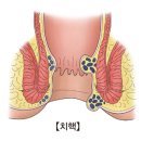 ﻿항문 및 직장의 궤양 이미지