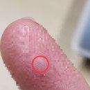 예원피부과의원 | 손가락에 가시 박혀서 병원 간 후기(시청역 예원피부과)