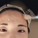 디유에스테틱 좁쌀 여드름 압출 가격 후기, 왕십리 피부관리