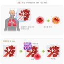 만성 이미지